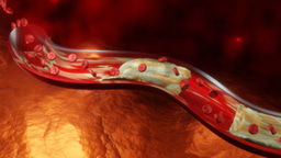 Peripheral arterial disease: symptoms, causes and management