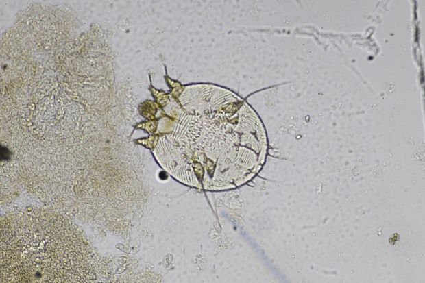 Scabies: symptoms and eradication