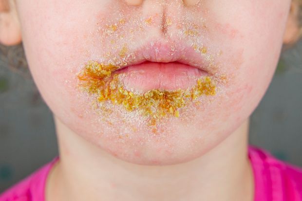 Nice guideline summary: Antimicrobial prescribing in impetigo