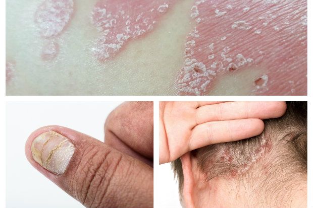 Psoriasis: forms and complications